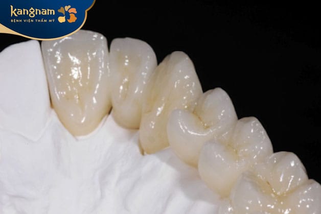 Loại răng sứ Emax CAD được chế tạo bằng công nghệ CAD/CAM