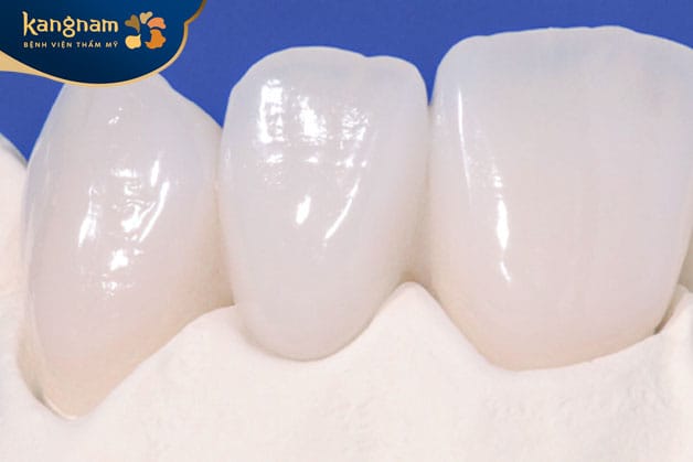 Mão sứ Emax Press là loại răng cổ điển nhất