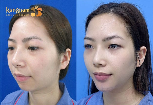 Kết quả từ khách hàng sau khi độn cằm tại Kangnam 