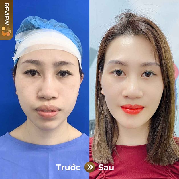 Diện mạo hoàn toàn mới sau khi chỉnh hàm hô 
