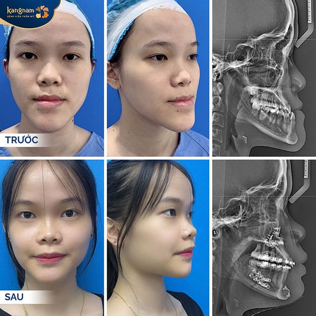 Khắc phục hoàn toàn tình trạng hàm móm 