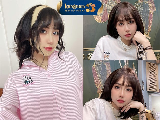 Khách hàng nhanh chóng sở hữu cằm thon gọn chuẩn Vline 