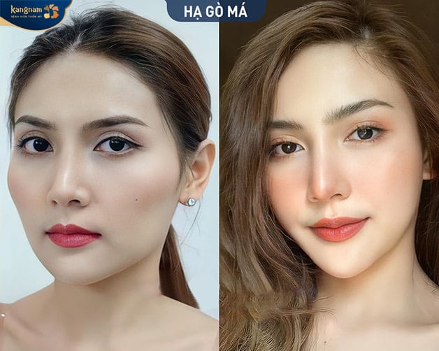 Nhan sắc cuốn hút, quyến rũ hơn sau khi hạ gò má 