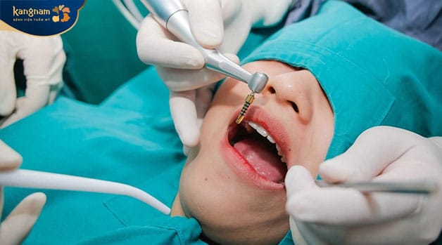 Cắm trụ răng Implant