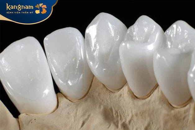 Đây là loại mão sứ hoàn toàn làm từ sứ Emax ZirCAD Prime
