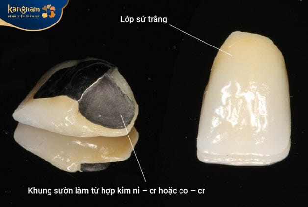 Răng sứ bọc kim loại thường