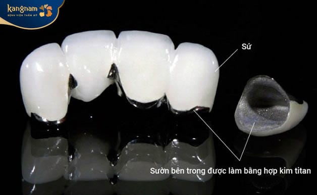 Răng sứ titan