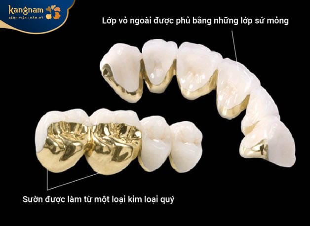 Răng sứ bọc kim loại quý