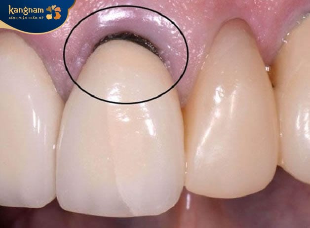 Có thể gây tình trạng đen nướu sau thời gian dài sử dụng