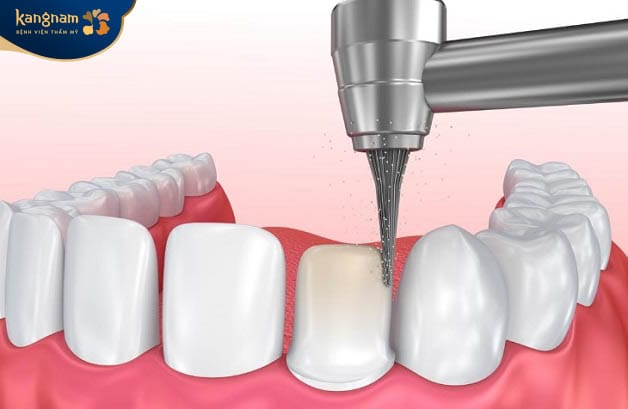 Mài răng, lấy khuôn tại răng sứ