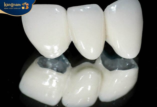 Metal Porcelain Crowns: An Affordable Option