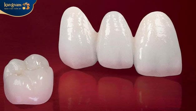 Răng toàn sứ Lava có tính thẩm mỹ cao