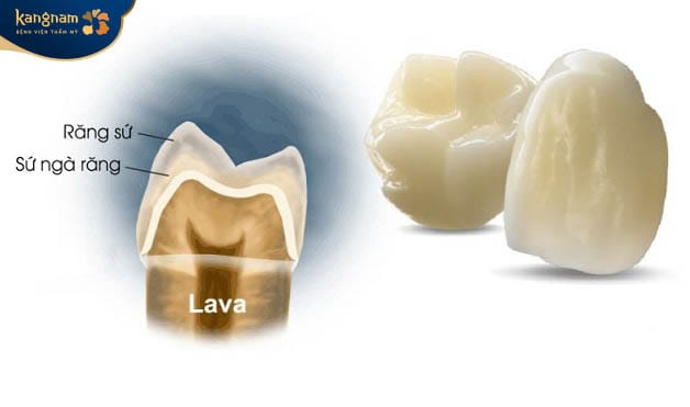 Lava Porcelain Crowns: Strength and Natural Beauty