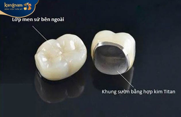 Titan Porcelain Crowns: Affordable and Durable