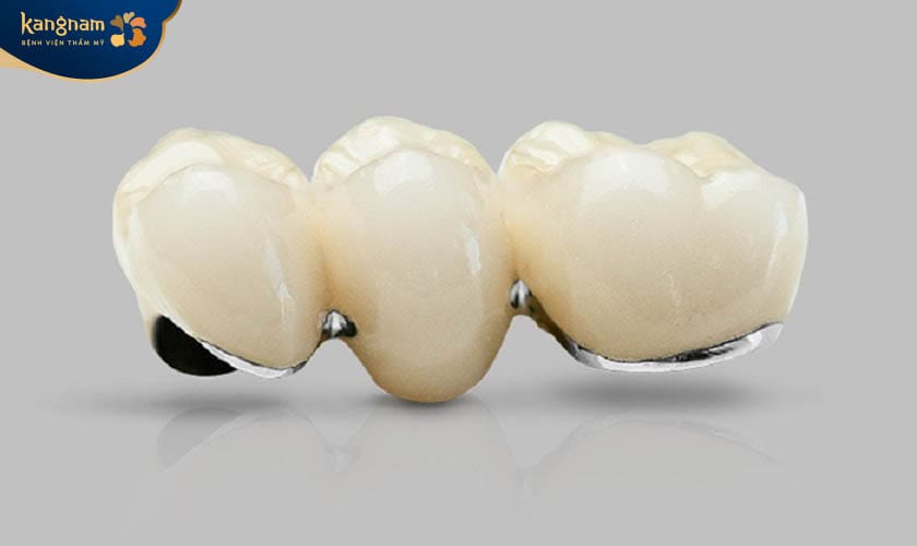 Răng Titan Vita có cấu tạo khung sườn chế tác 8% từ hợp kim titan