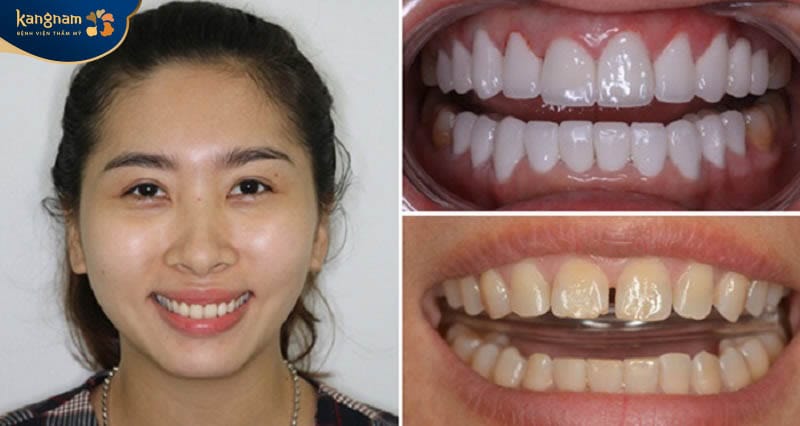 Chi phí bọc răng sứ Titan đang có giá 2.500.000 VNĐ/chiếc
