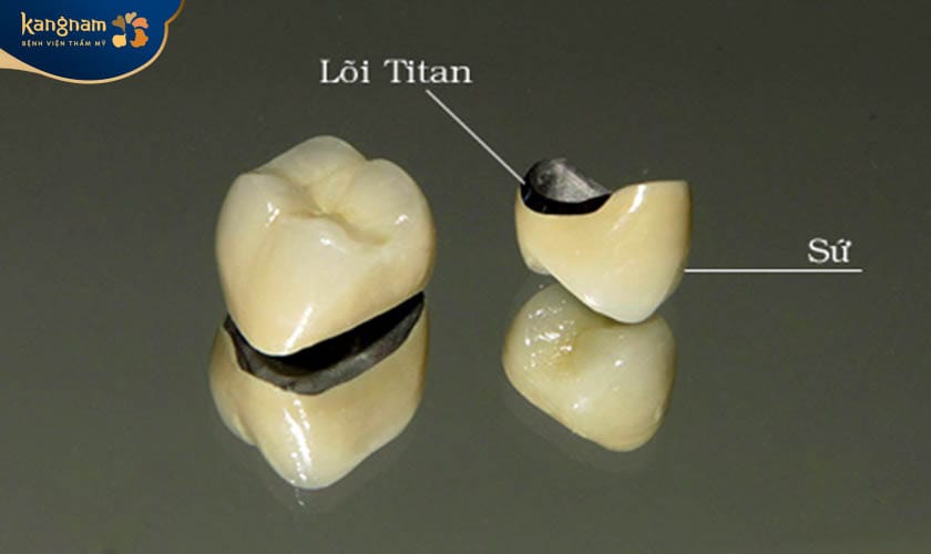 Mão sứ Titan Margin với khung sườn được làm bằng hợp kim titanium