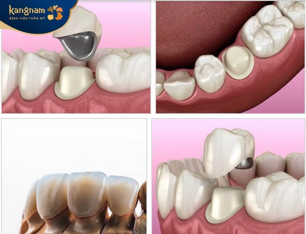 Răng Titan với nhiều ưu điểm nổi bật