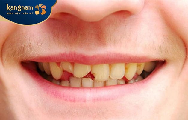 Những ai có hàm răng khấp khểnh, mẻ, sứt nên bọc sứ Venus để cải thiện 