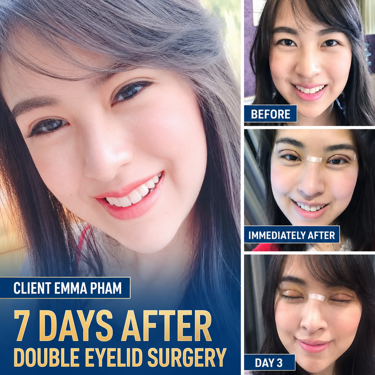 Overseas Vietnamese client experiencing rapid recovery after eyelid surgery at Kangnam