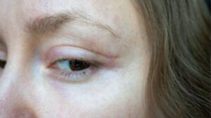 8 Ways to Reduce Swelling After Eyelid Surgery