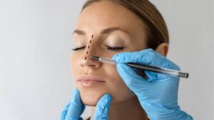 Revision Rhinoplasty: Correcting a Previous Nose Job