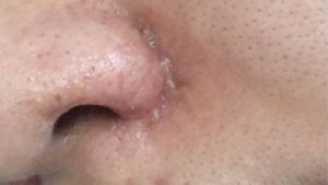 Scabbing on Rhinoplasty Stitches: Is It a Sign of Healing?