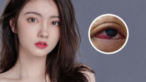 5 Risks of Epicanthoplasty (Eye Corner Widening) You Should Know