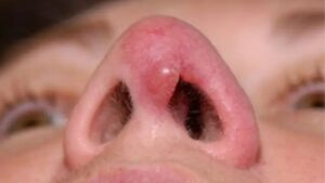 Signs Your Nose Is Rejecting the Implant