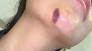 7 Signs of Filler Necrosis to Recognise Early