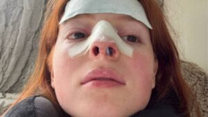 How Long Before You Can Sleep on Your Side After Rhinoplasty?