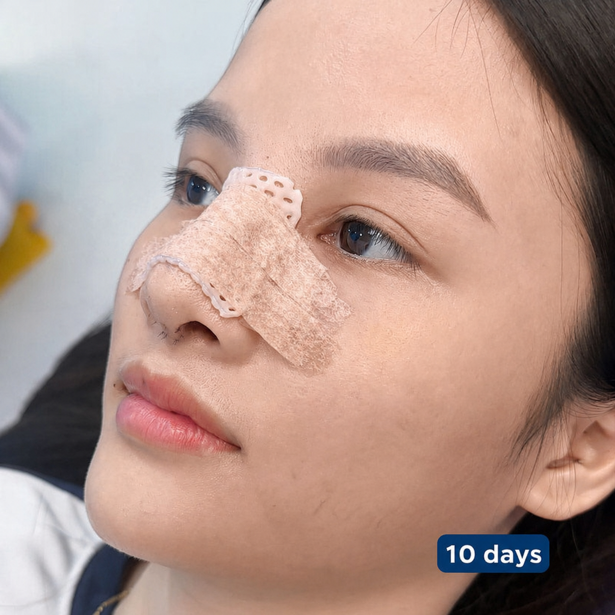 The recovery process after rhinoplasty.