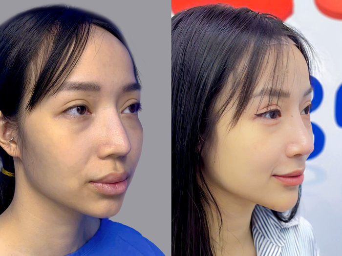 Ms. Hoa, 31 years old, an overseas Vietnamese patient from Australia.