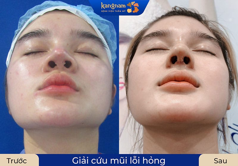 Kangnam thực hiện nhiều ca biến chứng mũi thành công