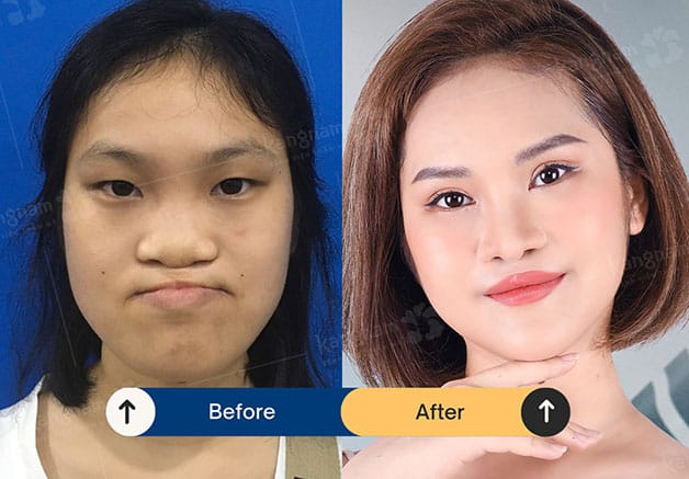 A deformed nose is fully reconstructed.