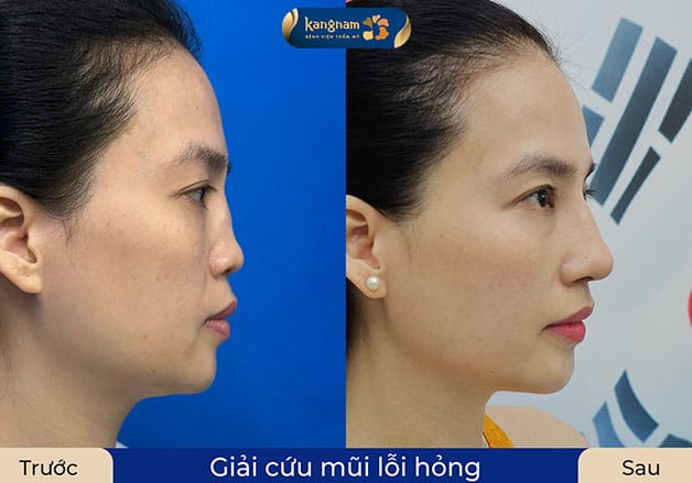 Mũi lỗi hỏng phức tạp nên cân nhắc lựa chọn nâng mũi sụn sườn