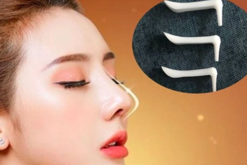 Nasal cartilage and implant materials are used to shape and support the nose.