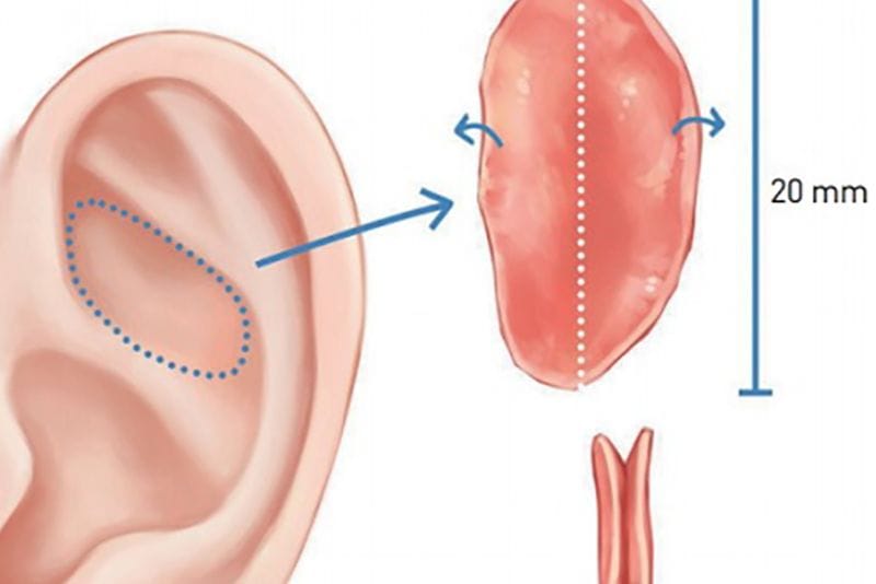 Autologous ear cartilage helps minimize the risk of nasal implant visibility.