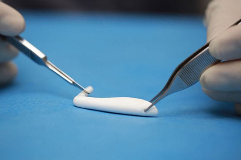 Rhinoplasty grafts and implants are materials used in surgical rhinoplasty procedures.