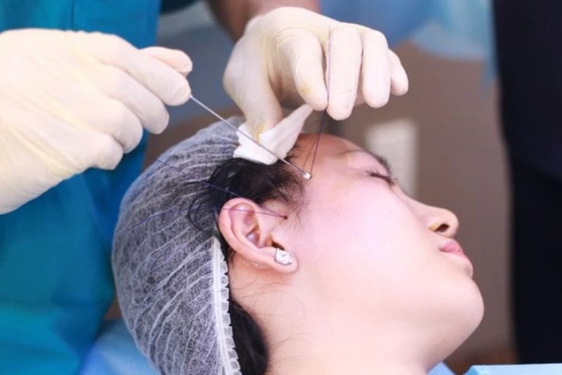 Severe allergic reactions or deep tissue injury may require early thread removal.