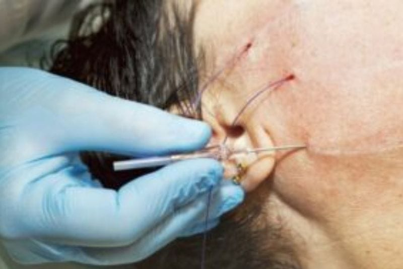 Incorrect thread placement may increase the risk of adverse effects.