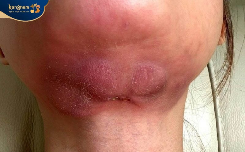 The double-chin area may develop infection, tissue injury, or necrosis after unsafe injections.