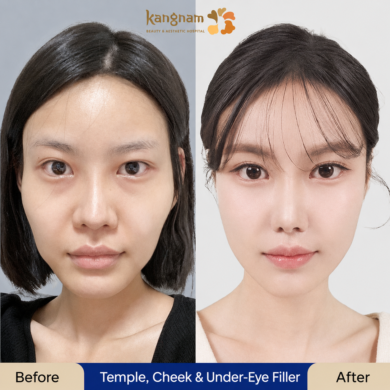 Filler may restore volume to hollow temples and improve facial contours.