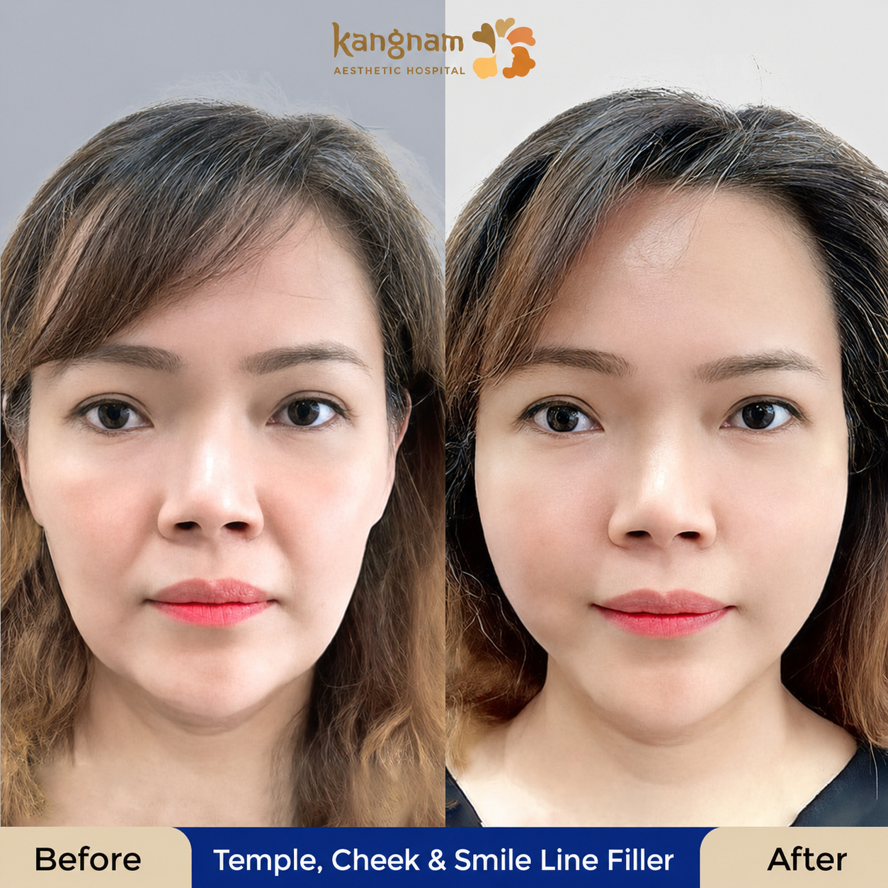 The face may appear softer and more proportionate after filler is placed in the temples, cheeks, or facial folds.