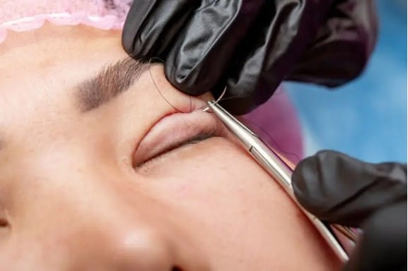 The method and complexity of suture removal may affect the final price.