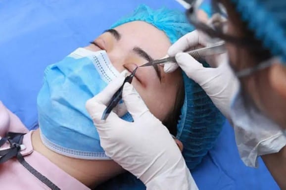 Double-eyelid suture removal is usually performed with local anaesthesia to control discomfort.