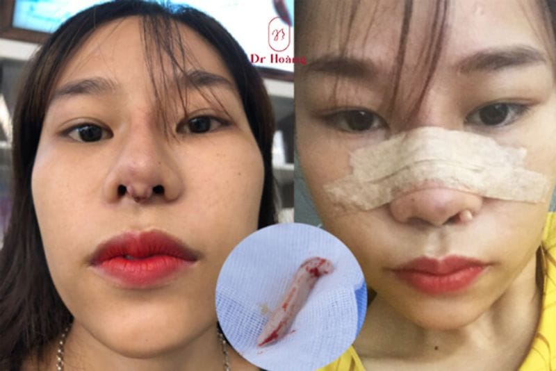 The nose may return close to normal after implant removal, but it may not look completely the same as before rhinoplasty.