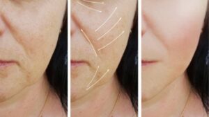 Thread Lift for Skin Rejuvenation (see Collagen Thread Lift)
