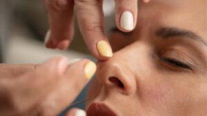 Thread Lift Rhinoplasty Complications and How to Avoid Them