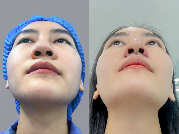Direct alar excision requires careful planning to avoid excessive narrowing or visible scarring.
